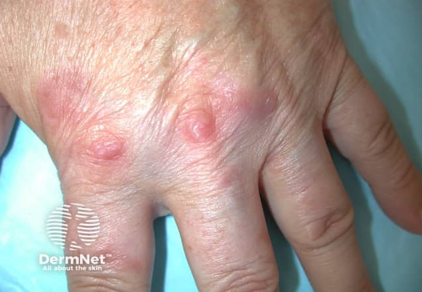 Subtle granuloma annulare