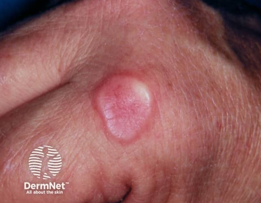 Early granuloma annulare bumps