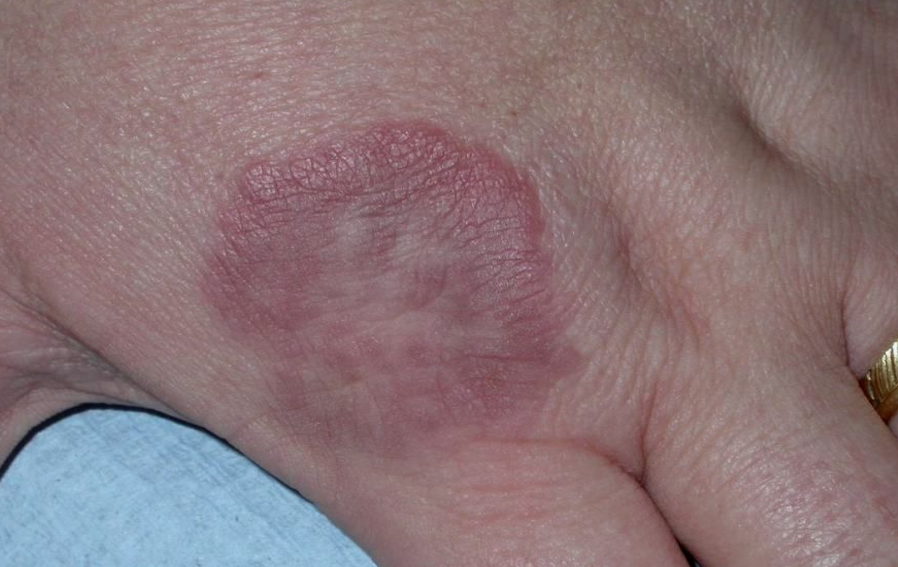 Ring shaped granuloma annulare