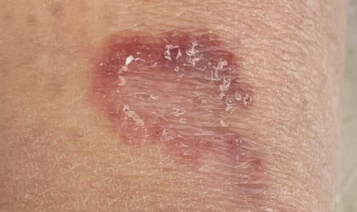 Granuloma annulare ring lesion representative