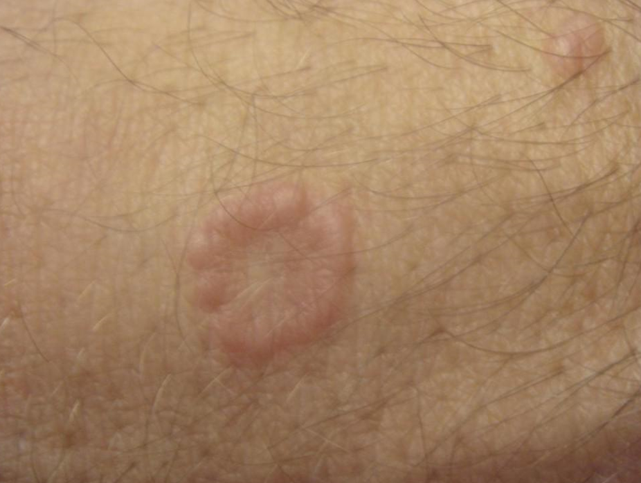 Granuloma annulare on hand