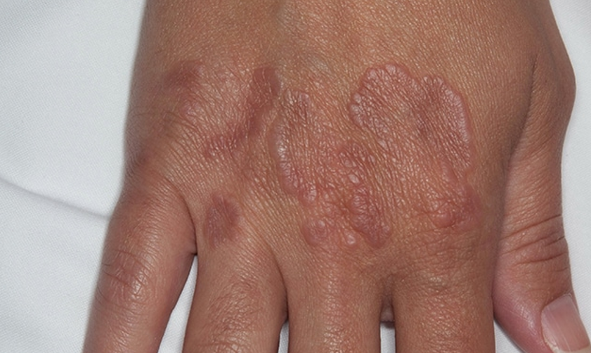 Granuloma annulare fingers